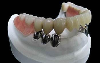 Telescope crowns and denture