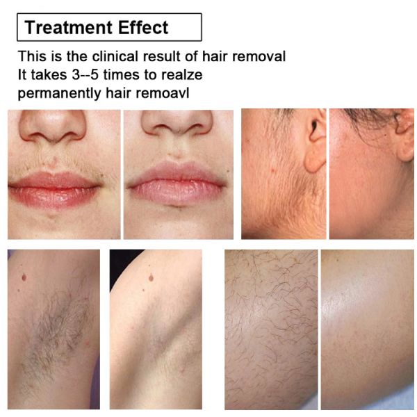 Beauty Salon 810nm Diode Laser Hair Removal Equipment Professional