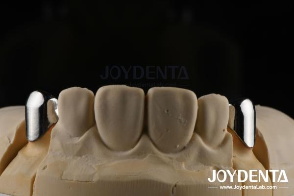 Precision Removable Prosthesis Dental Implant Attachments Easy Clean Comfortable Fit