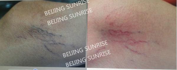 2016 new 980 nm laser spider veins removal Blood Vessels Removal