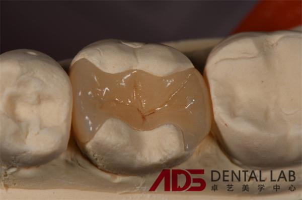 Seamless Porcelain Emax Veneers Teeth Replacement Authentic Looking