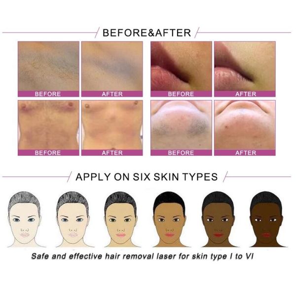 Newest design 755/808/1064nm combination diode laser hair removal machine