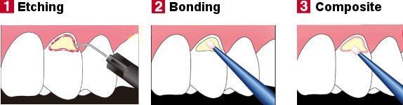 Ультра крепко лощить Все-керамический полировать кроны имплантируйте Dentures зубоврачебные