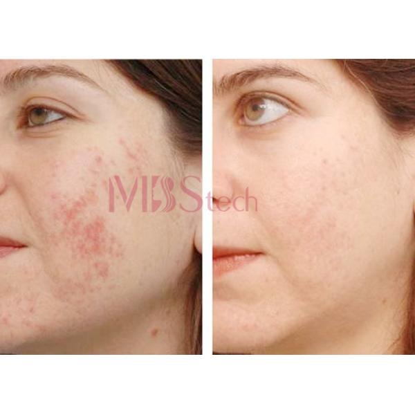 Skin Rejuvenation Face Lifting Thermagic Microneedle RF Machine