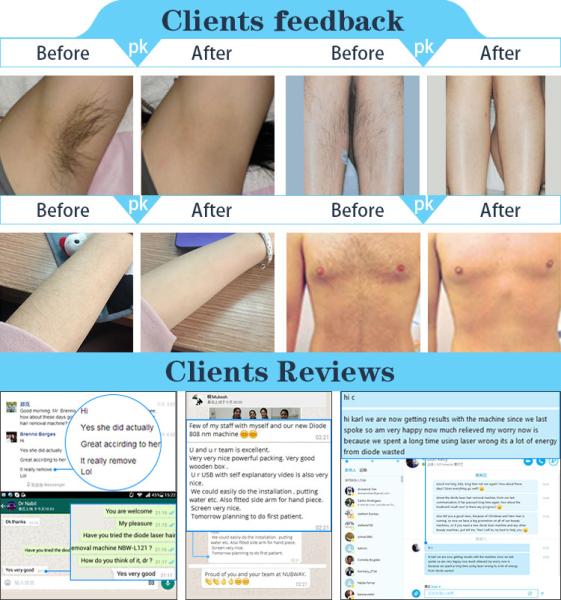 Nubway portable home laser diode machine / laser hair removal diode equipment