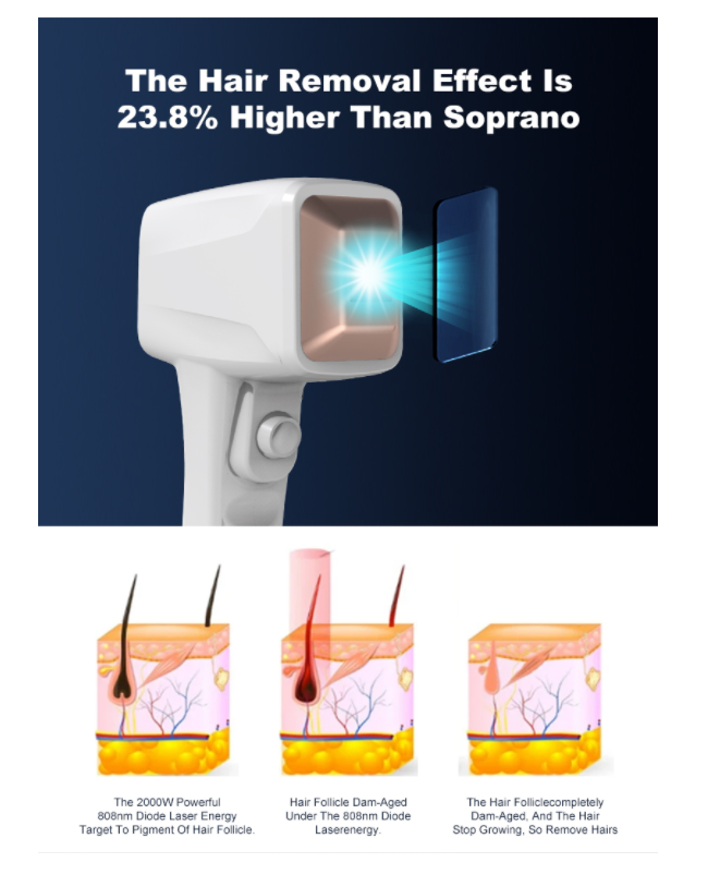 Diode Laser Permanent Hair Removal Machine 4 Wavelength 755nm 808nm 940nm 1064nm