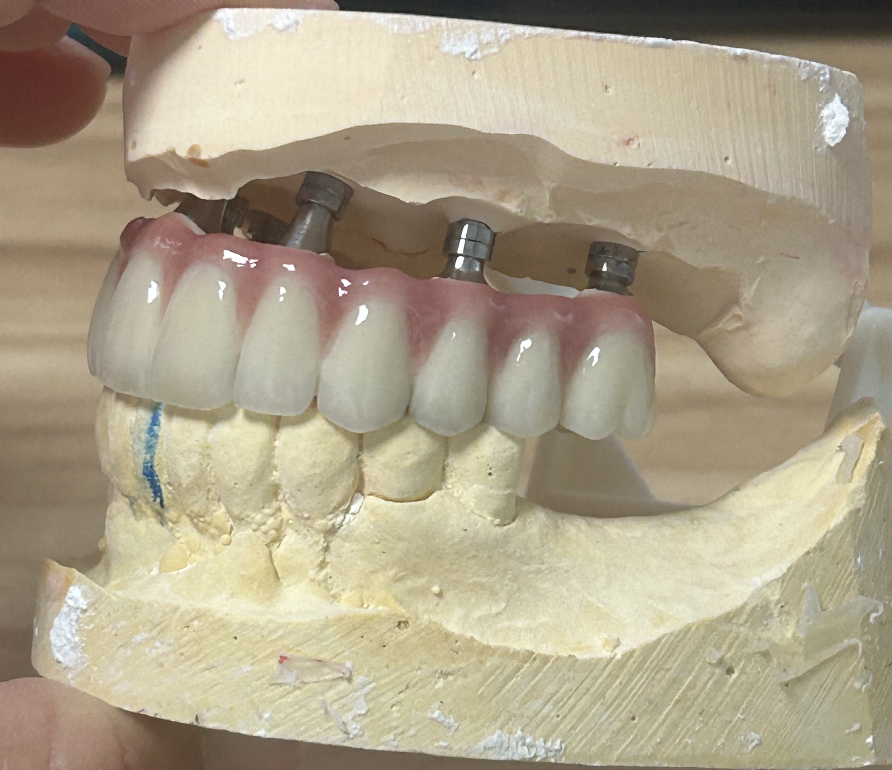 High-Strength Dental Zirconia Implant Crown with Natural Translucency & Tooth-Like Appearance via Digital CAD/CAM