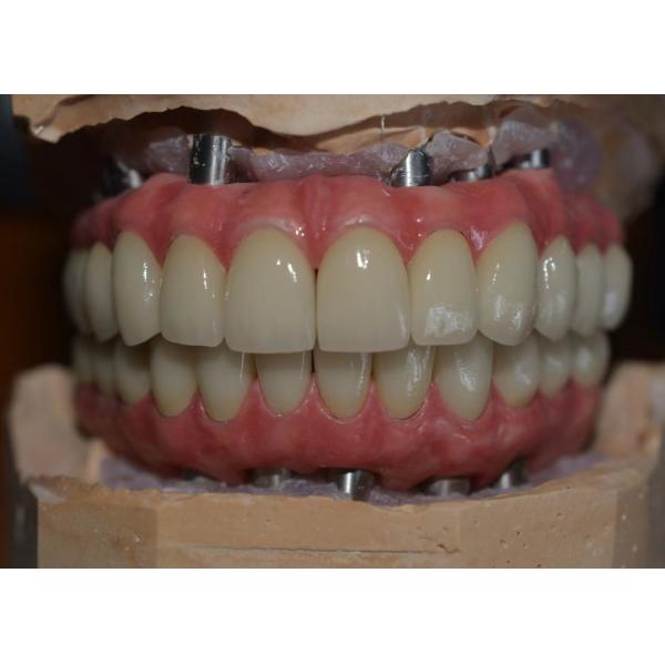 Кронки для зубных имплантатов, изготовленные с высокой точностью, для комфорта и уверенности