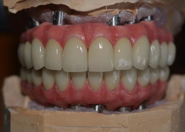 Precision-Crafted Dental Implant Crowns for Comfort & Confidence