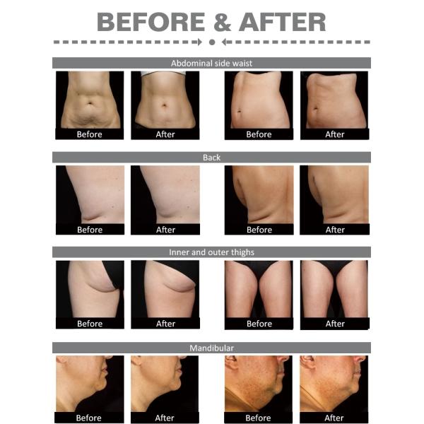 Non-Invasive Body Slimming With 1060nm Diode Laser Lipolysis Fat Removal Machine Sculpsure Warm Sculpting