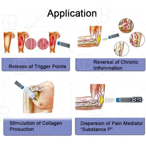 200мж радиальная ударная волна терапия для теннисиста локтевой и суставной боли
