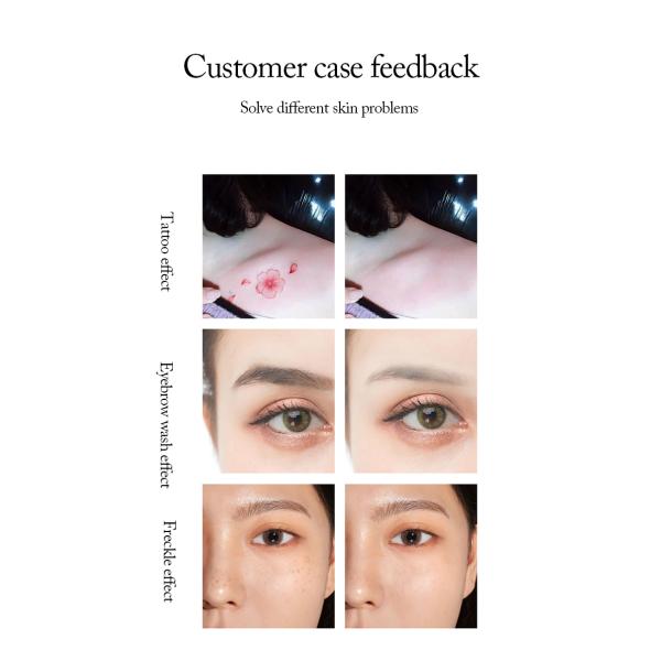 Tattoo Remove Spot And Fine Lines Removal Machine Nd Yag Laser Carbon Peeling