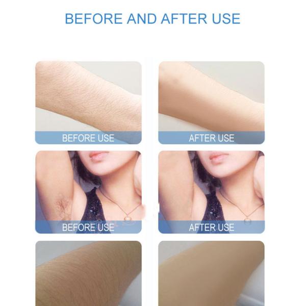 Машина лазера диода подмолаживания 808nm кожи для удаления волос