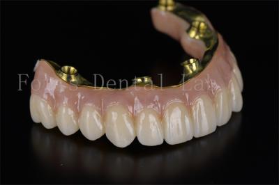 Full Mouth Reconstruction All On 4 All On 6 Dental Implant System