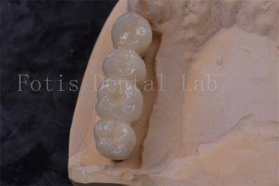 Precision Fit Zirconia Tooth Crown Implant PFM Crown Easy To Clean
