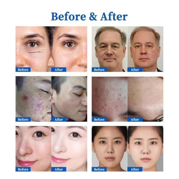 Anti-acné, eliminación de pecas, levantamiento de piel, pluma de plasma, máquina de eliminación de mentón doble