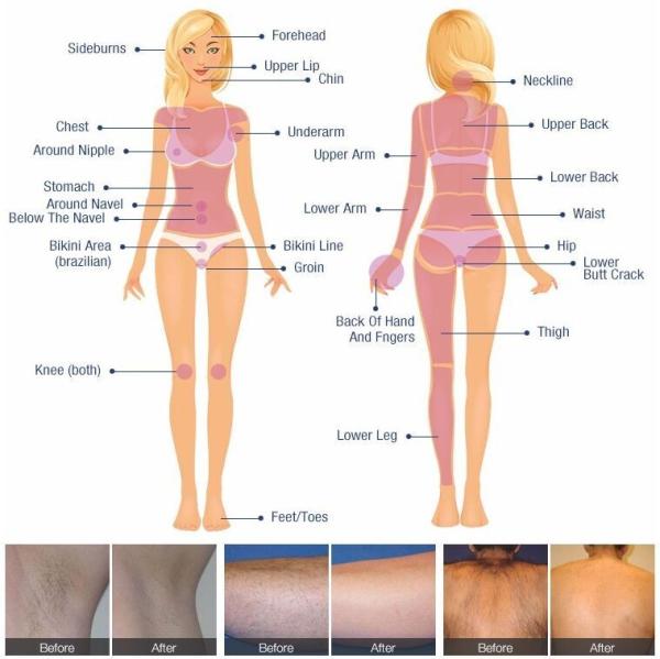 Máquina permanente da remoção do cabelo do laser do diodo 808, máquina da depilação do laser da cosmetologia