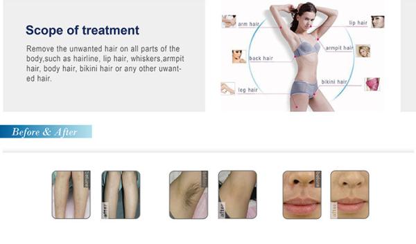 Tri cooling 12 hours constant working Portable diode laser hair removal machine easy work