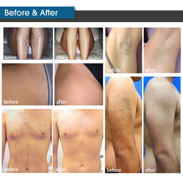 Diode Laser Hair Removal Machine ADSS Fast and Permanent 808nm Ce Stationary Abs for Commercial & Home Use,for Commercial CN;BEI