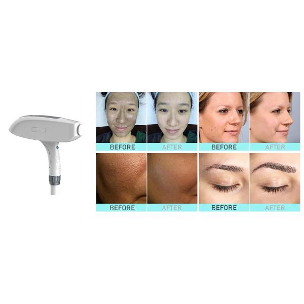 Portable Apple Laser Tattoo Removal Machine For Men Q Switch ND Yag Lser