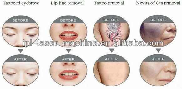 Discount price! Discount price! nd yag laser tattoo and nail fungus removal for tattoo removal, age pigment & freckle re