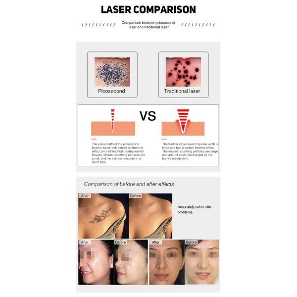 OEM машины 2000mj пикосекунды удаления татуировки лазера Nd Yag