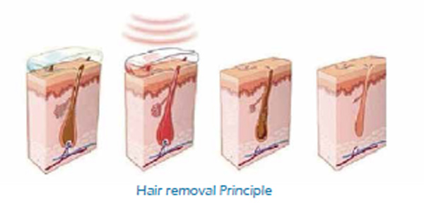 SHR hair removal and skin rejuvenation machine effective immediately