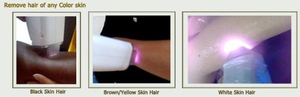 Alexandrite Diode Laser Hair Removal Machine 808