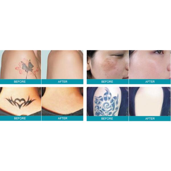 532nm / 1064nm Pigmentation Removal Q Switched Nd Yag Laser Skin Rejuvenation Machine