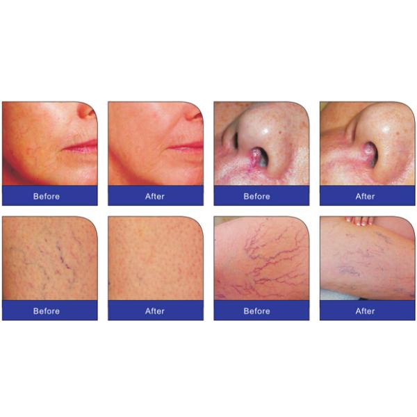 United States 8.0 Inch Touch Screen Spider Vein Removal Machine Vascular Removal