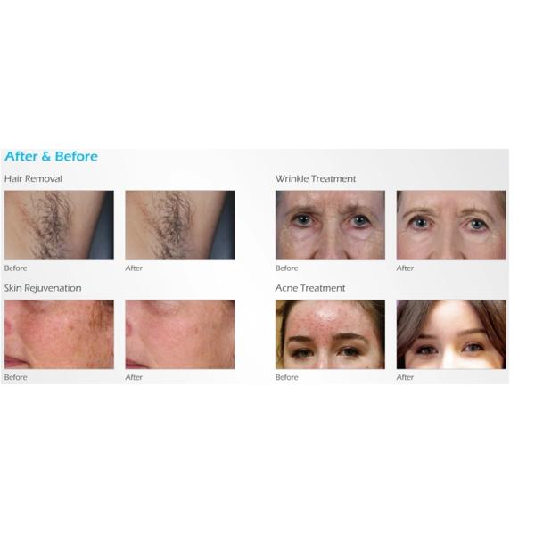 Economic High Power SHR Elight Hair Removal Machine Efficient For Full Body