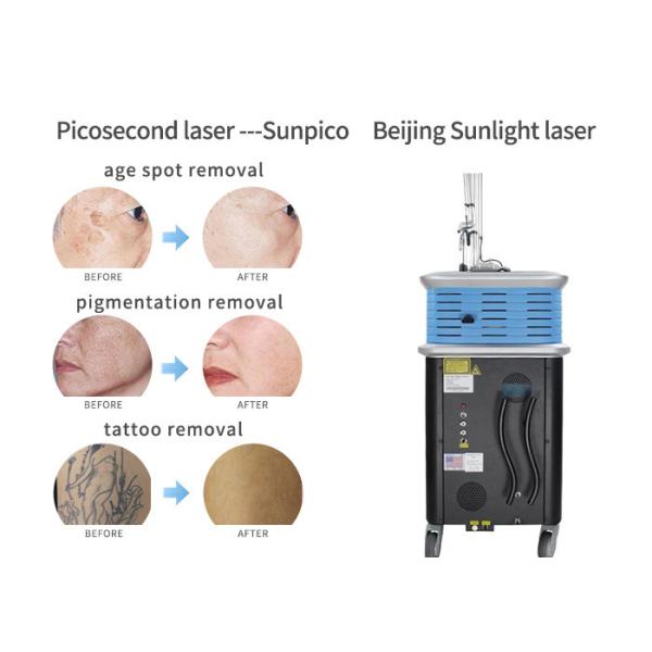 Painless Picosecond Laser Tattoo Removal Machine 755m Two Years Warranty