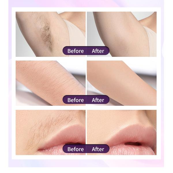STANDING Beauty Machine for Skin Rejuvenation and Diode Laser Hair Removal 755 808 1064nm