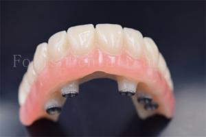 Customized Dental Implants Crowns Replacement Wear Resistance