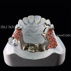 Precise Fit Removable Dentures Metal Framework Customized