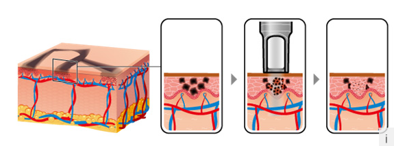 Профессиональный мини живот машины K6s удаления татуировки лазера 1320nm для пигмента кожи