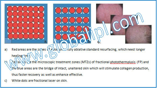 Acne And Acne Scar Removal CO2 Fractional Laser Machine With Air Cooling System