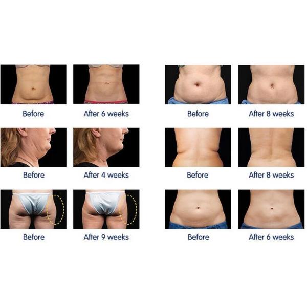 Vertical professtional cryolipolysis cavitation rf lipolaser slimming machine