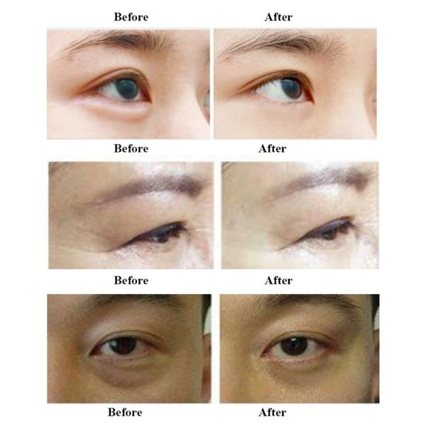 Dual Handle RF Face Lifting Machine For Skin Firming / Rejuvenation
