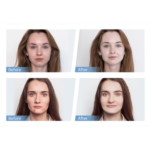 Совсем новая Hydra.Pen H5 Микроигловой аппликатор сыворотки