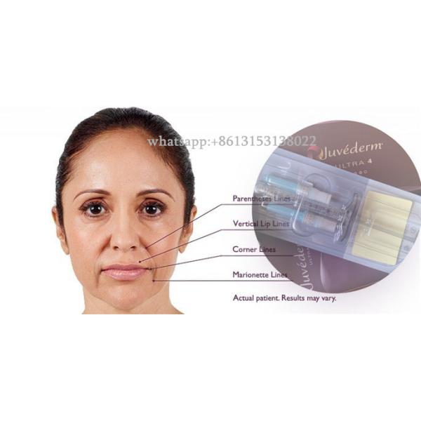 Впрыска лицевого заполнителя продолжительная Ultra3 Ultra4 Voluma Juvederm Hyaluronic кисловочная