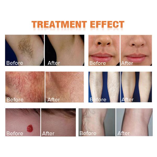 Máquina 1064 del laser del Alexandrite del Nd YAG permanente del retiro del pelo de 755 lasers