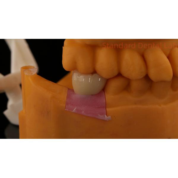 Dental Implant Screw Retained Crown PFZ Porcelain Layered Zirconia With 3D Print Model