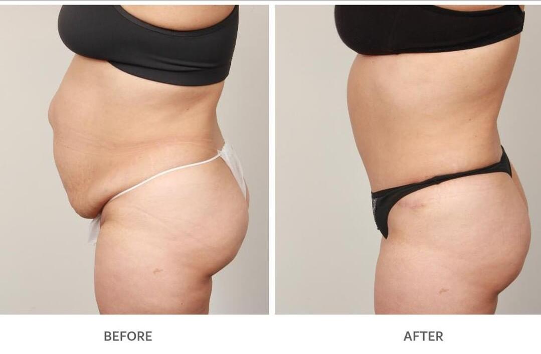 Портативный лазер Lipo уменьшая прибор для воздушного охлаждения потери Tummy жирного