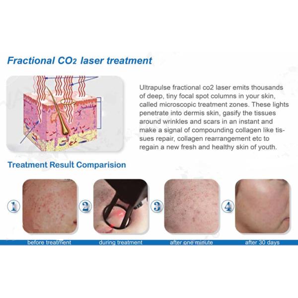 Beauty+ Cutting+Vaginal tightening the most professional RF fractional CO2 laser 100% USA Coherent RF tubeequipment