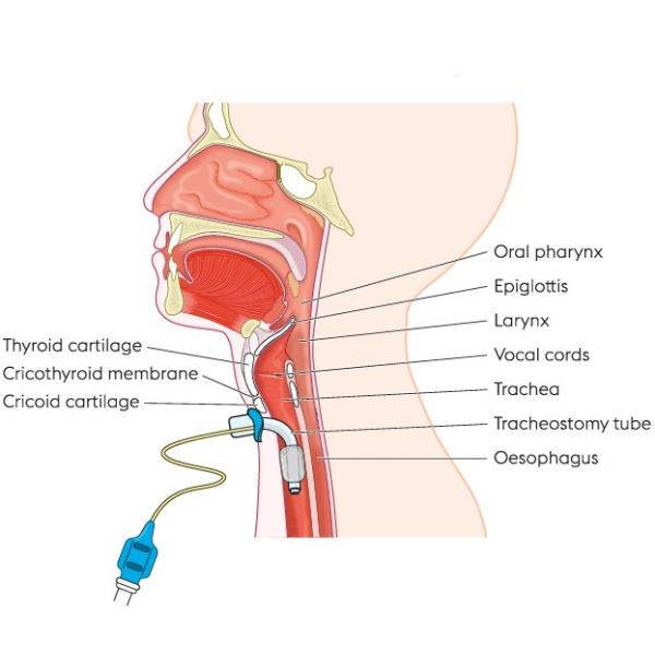 4.5 мм Медицинский класс ПВХ и субглотический CE ISO сертифицированный поставщик труб трахеостомии