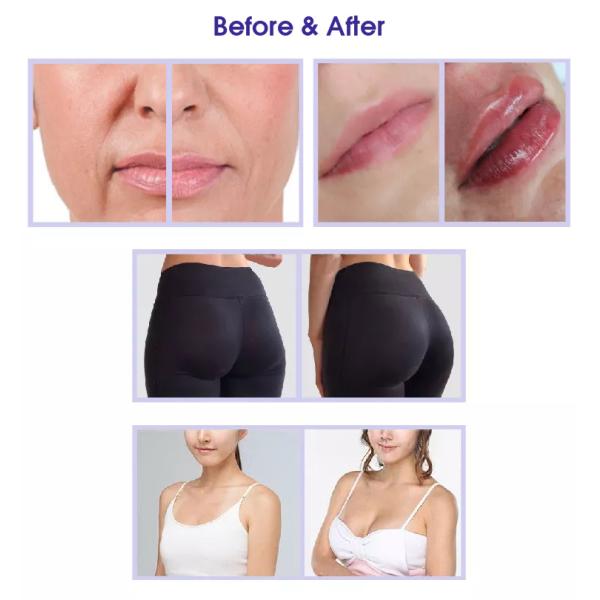 Перекрестный соединенный Filer губы 24mg 1ml Hyaluronic кисловочный дермальный с Lidocaine