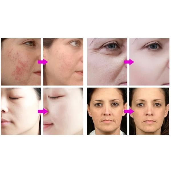 Rejuvenecimiento de la piel portátil LED terapia fotónica máscara de cuidado de la piel LED luz máscara facial