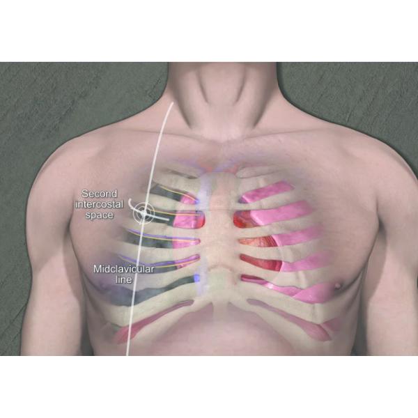 Pneumothorax Needle Chest Tension Cathether Needle trauma Decompensation Needle