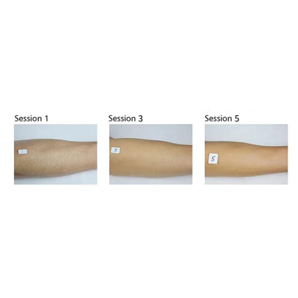 Painless Ice Laser Hair Removal Machine  755nm 808nm 1064nm With Speed Diode Handpiece